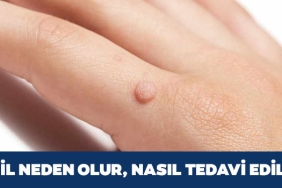 Siğil Nasıl Geçer