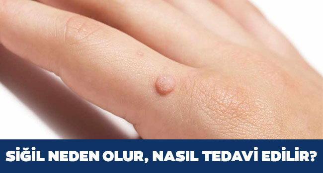 Siğil Nasıl Geçer